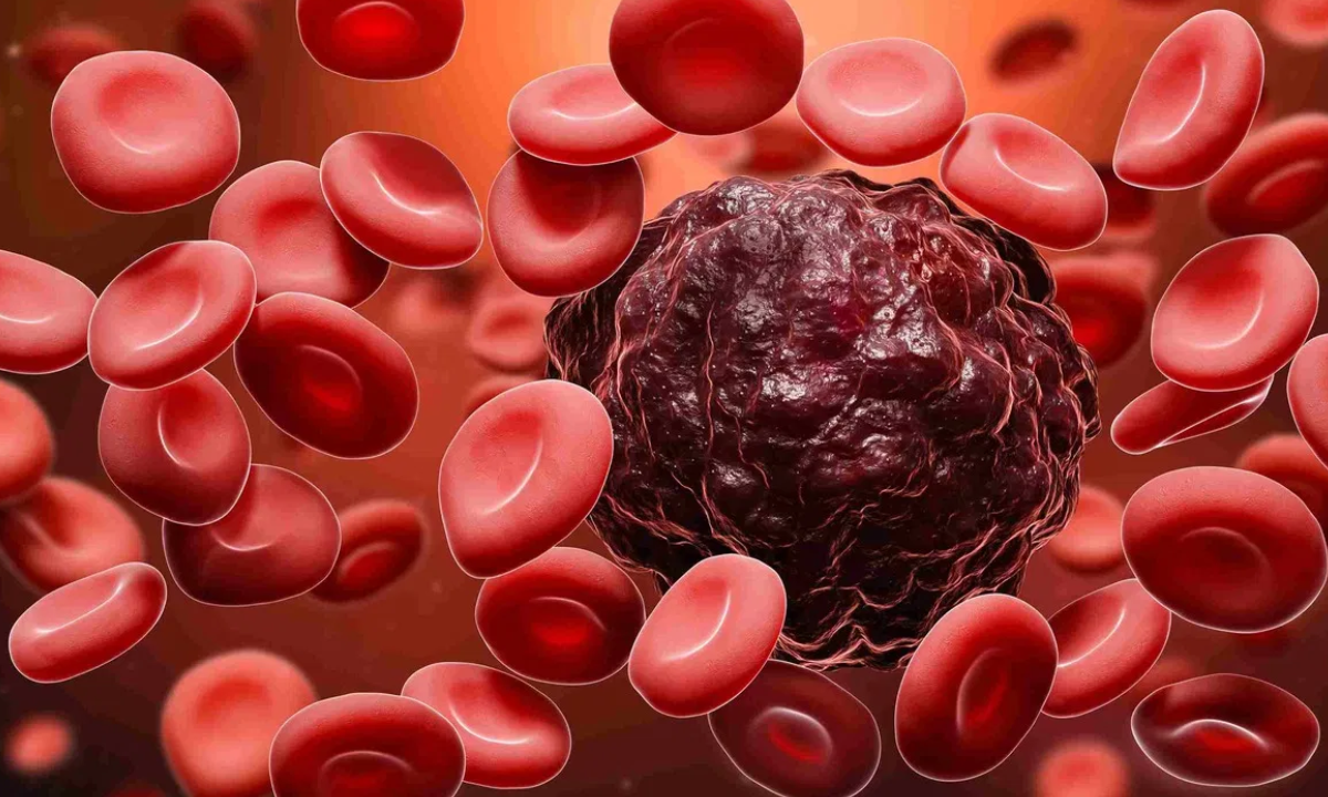 Blood Cancer: What Is It, How Is It Diagnosed, and How Is It Treated?