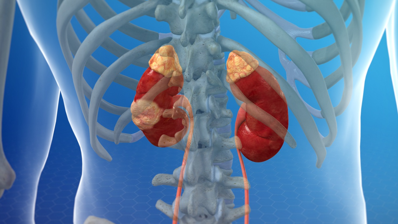 Kidney Cancer and Chronic Kidney Disease: What’s the Connection?