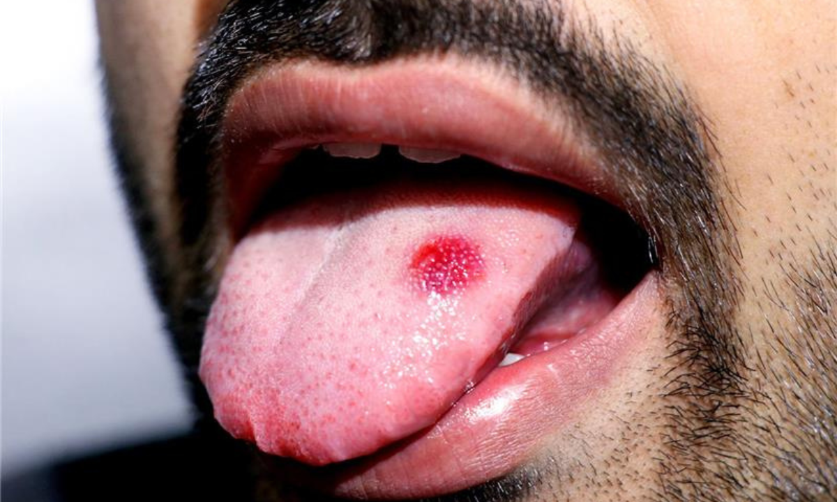 Tongue Cancer in India: Understanding the Risks and Prevalence 
